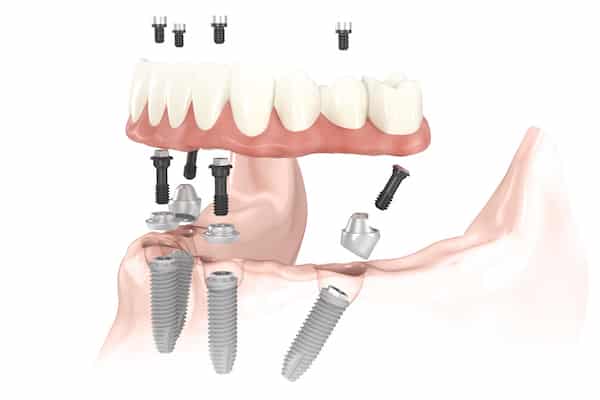 Implant retained dentures midland