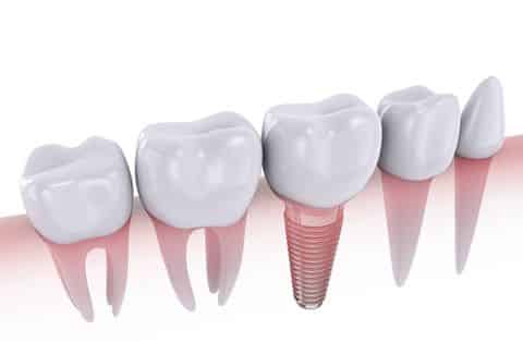 Dental Implant midland